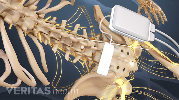 Abbott Spinal Cord Stimulator Manual