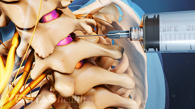 Epidural steroid injection into the epidural space of the cervical spine.