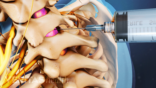 An illustration of a adult cervical spine with a needle injected in the cervical space.