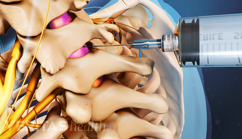 Illustration showing cervical vertebrae with a needle inserted.