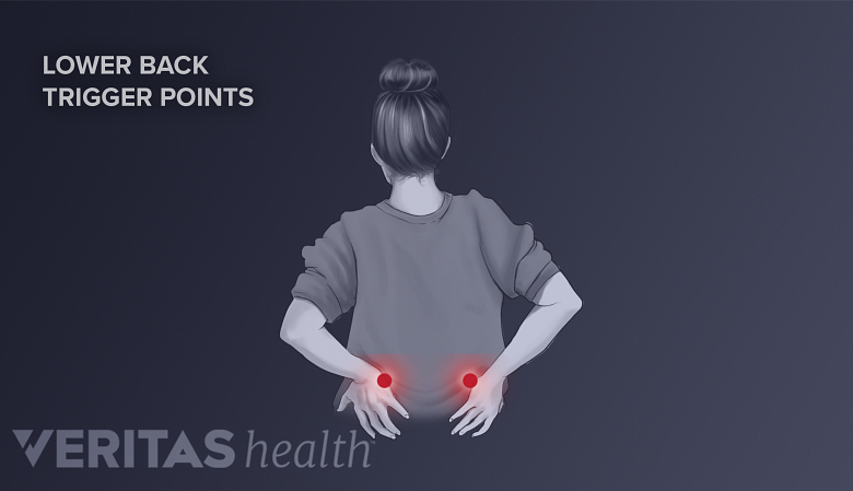 An illustration showing a woman holding her back with trigger points highlighted in red.