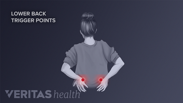 An illustration showing a woman holding her back with trigger points highlighted in red.