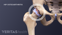Illustrated skeleton showing osteoarthritis in the hip joint