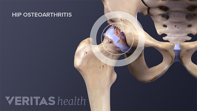 Medical illustration of osteoarthritis in the hip joint