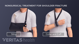 肱骨骨折患者使用吊带或项圈，第二插图显示使用袖带。