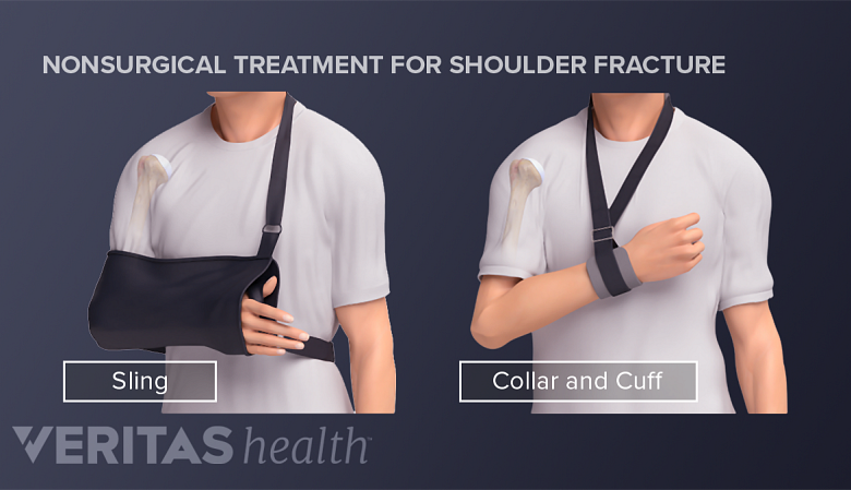 Person with a humerus fracture using a sling or collar and second inset showing using a  cuff.