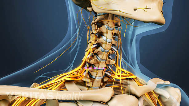 Medical illustration of the cervical spine, nerves are visible.