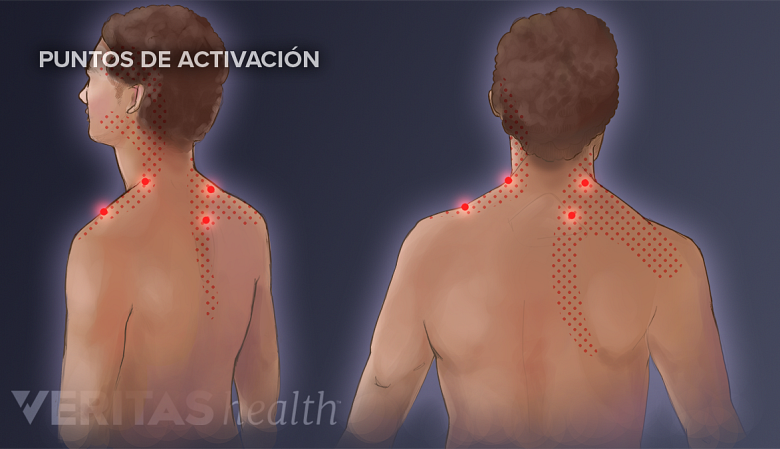 Puntos de activación en el cuello.