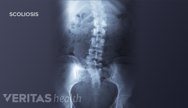 X-ray of spine with scoliosis.