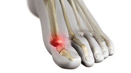 脚部骨骼图显示大脚趾疼痛