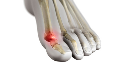 Illustration showing pain caused by gout in the big toe