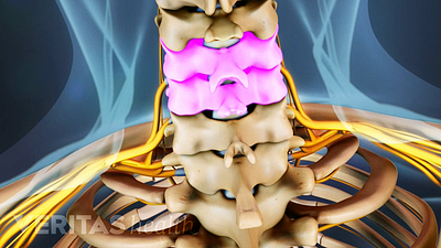 Posterior view of the cervical spine highlighting spinal stenosis.