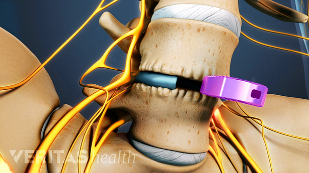 Ilustración médica que muestra un implante de jaula ALIF.