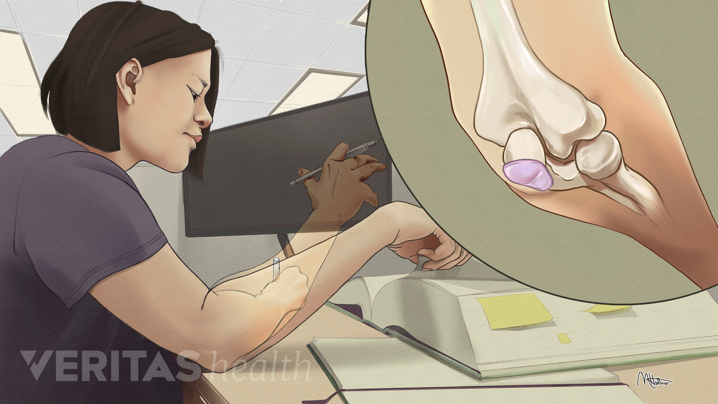 Woman studying, leaning on elbow while moving her arm around. Inset shows elbow bone structure with bursitis