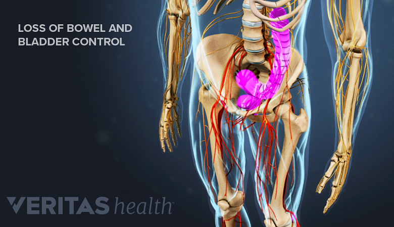 Illustration showing pelvis aea with bowel and bladder highlighted in pink.