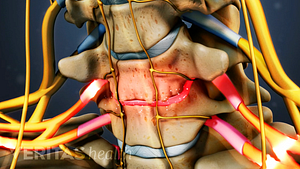 Anterior view of nerve root compression from cervical degenerative disc disease
