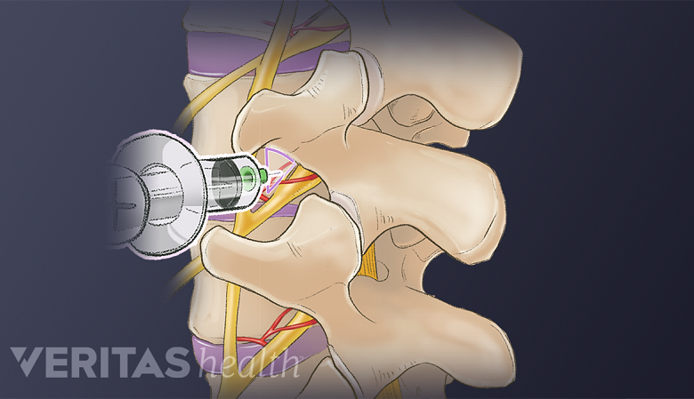 An illustration showing cervical spine with a needle injected into it.
