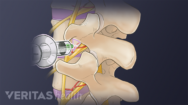 Una ilustración que muestra la técnica de inyección epidural.