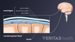 Anatomy of meningitis in the spinal fluid