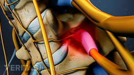 Medical illustration showing spinal stenosis causing nerve impingement in cervical spine