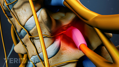 Profile view of spinal stenosis between two cervical vertebrae.