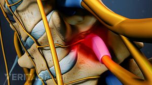 Medical illustration showing spinal stenosis causing nerve impingement in cervical spine