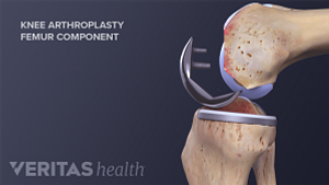 Illustration showing the patellar component of an artificial knee