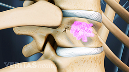 Medical illustration showing bone cement being inserted into a fractured vertebra