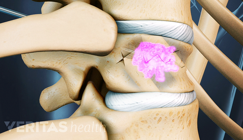Illustration showing fractured cevival vertebra highlighted in pink.