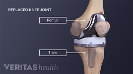 Medical illustration of a completed knee replacement labeling tibia and femur