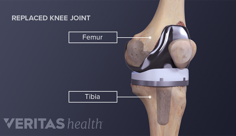Types of Knee Surgery for Arthritis Treatment
