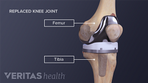 Anterior view of the knee joint showing replacement hardware.