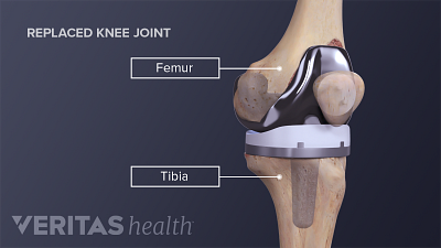 Medical illustration of a completed knee replacement labeling tibia and femur