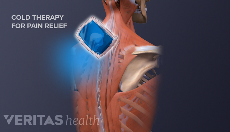 Illustration showing posterior view of neck and upper back with an ice pack icon.