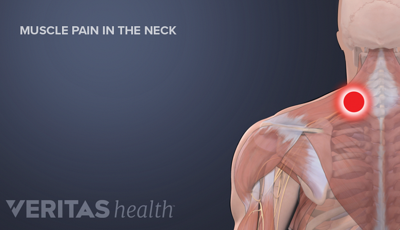 Illustration showing muscles of the neck highlighted with a red dot.
