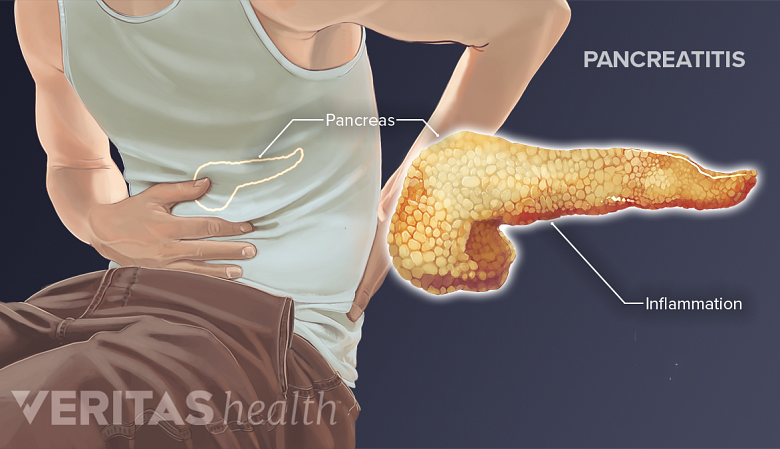 Medical illustration of pancreatitis