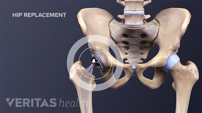 Medical illustration showing a completed hip replacement