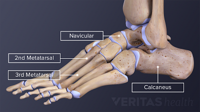 Lateral view of the bones of the foot labeling 2nd metatarsal, 3rd metatarsal, navicular, and calcaneus.