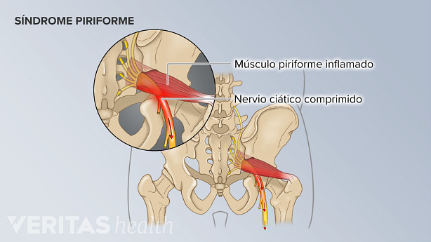 Un músculo piriforme inflamado que comprime el nervio ciático en la parte baja de la espalda.