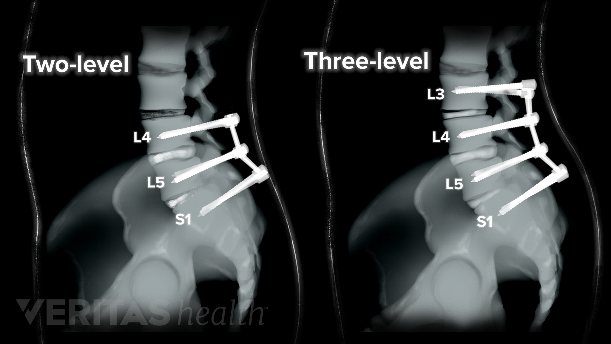 Multilevel Spinal Fusion For Low Back Pain | Spine-health