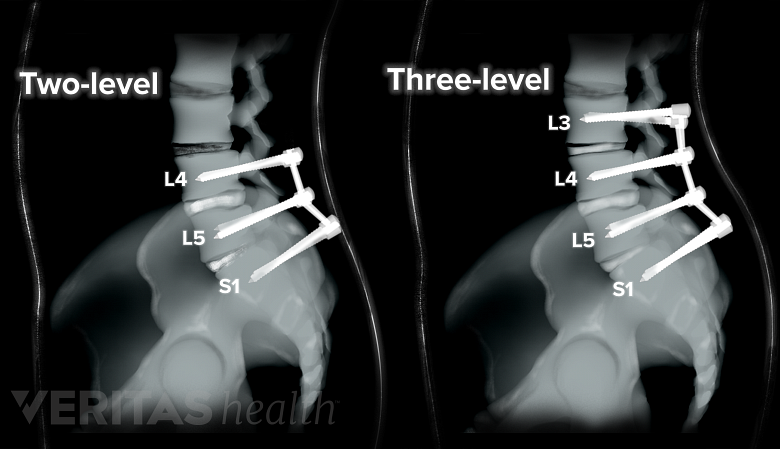 Illustration showing x-ray of lower spine with multilevel fusion.