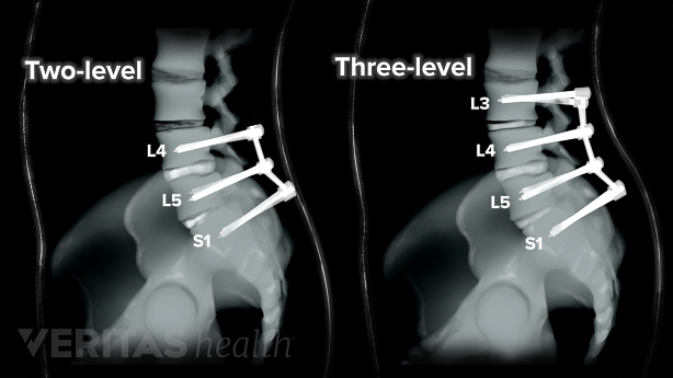 Illustration showing xray of lumbar spinal fusion.