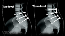Comparison x-ray images of a two and three level spinal fusion