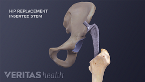 Medical illustration of a femoral stem being inserted into the femus as part of a total hip replacement