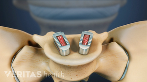 Spinal fusion pieces in the pelvis below the lumbar spine.