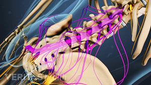 Medical illustration showing the cauda equina nerve roots in the lumbar spine