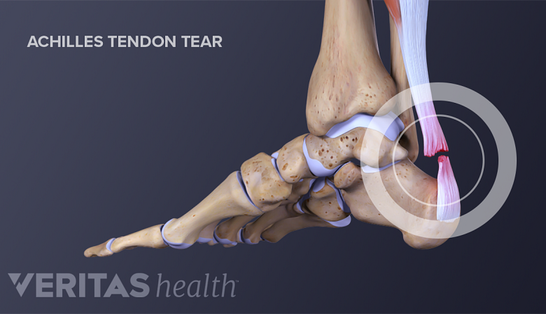 Medial view of the foot showing a rupture of the achilles tendon.