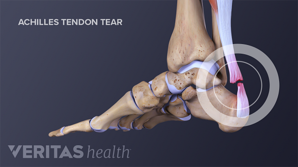 足部内侧视图显示跟腱断裂。