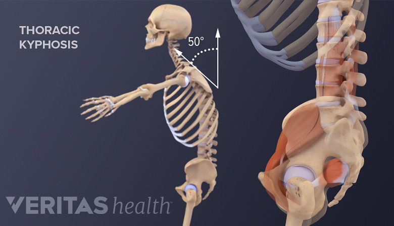 Profile vide of pelvis and whole body showing thoracic kyphosis.
