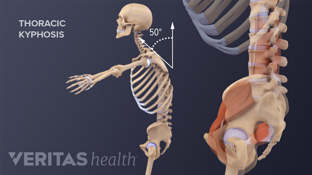 Profile vide of pelvis and whole body showing thoracic kyphosis.